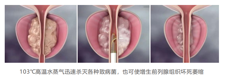 瑞梦治疗前列腺的原理