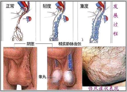 精索静脉曲张