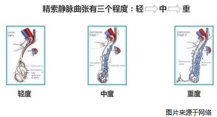 精索静脉曲张能治疗吗